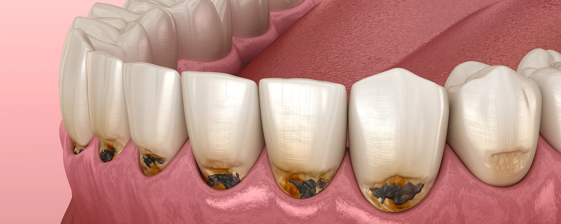 虫歯治療について