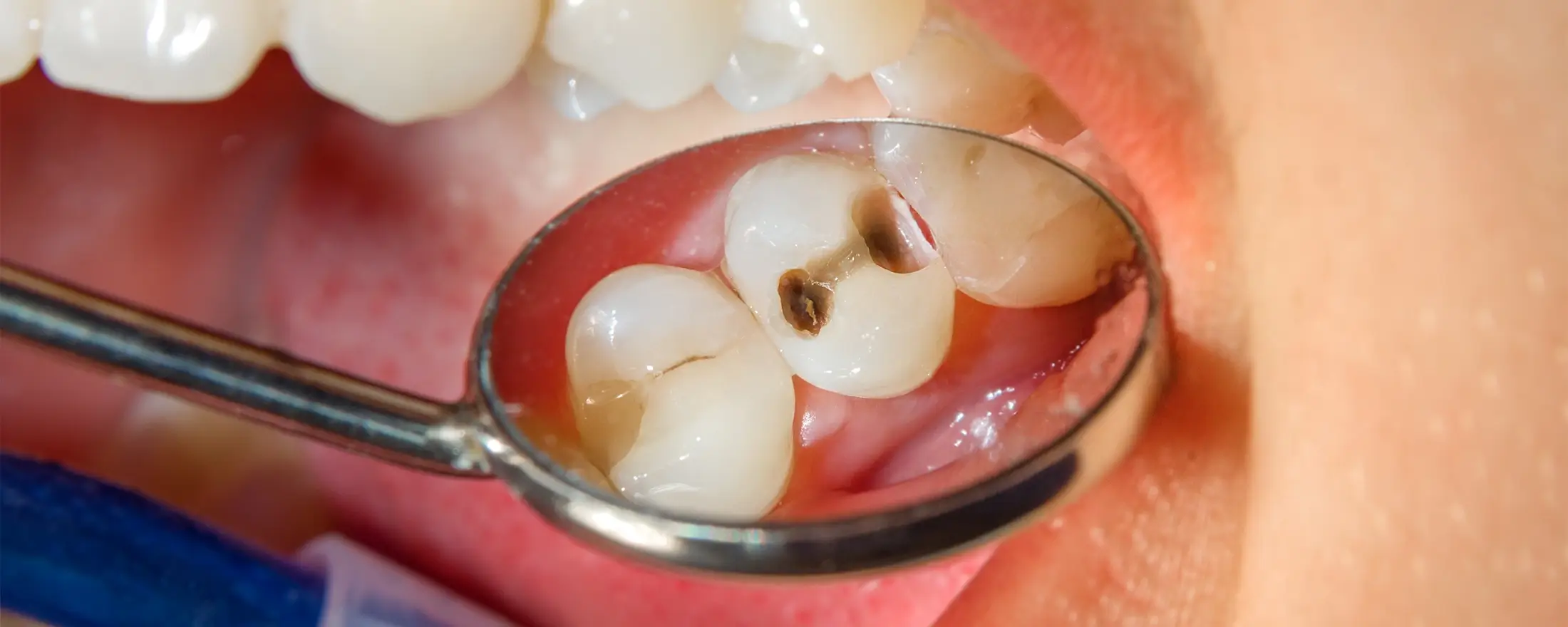 ダイレクトボンディングによる虫歯治療の特徴