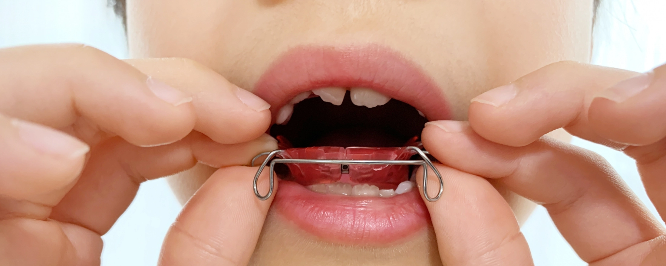 3.成人矯正との違い