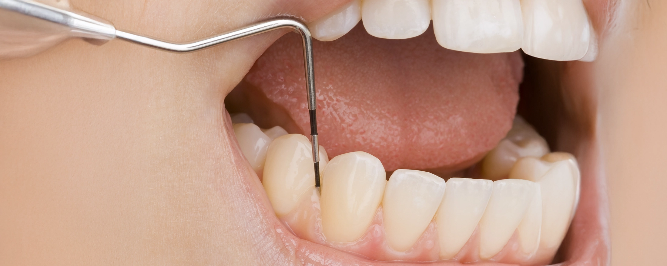 歯周病を予防するために必要なことを教えてください。