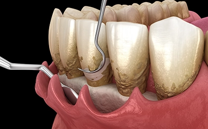フラップ手術(歯肉剥離掻爬術)