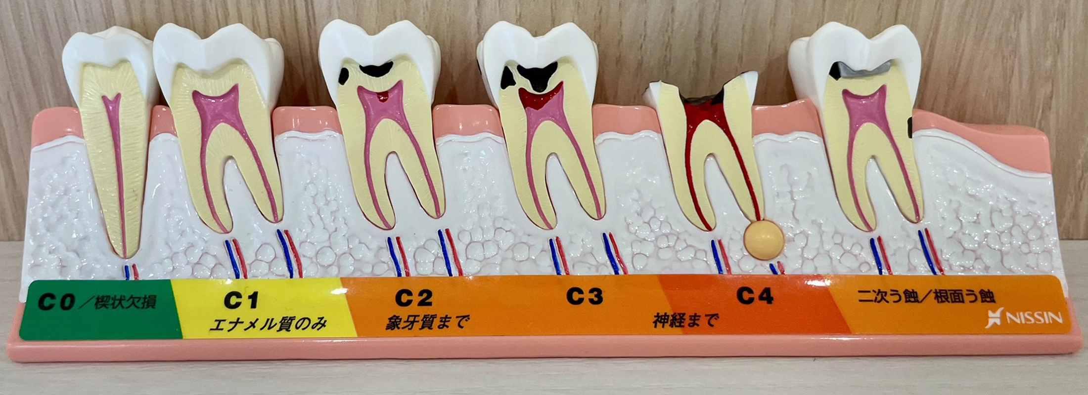 歯髄温存療法(VPT)について